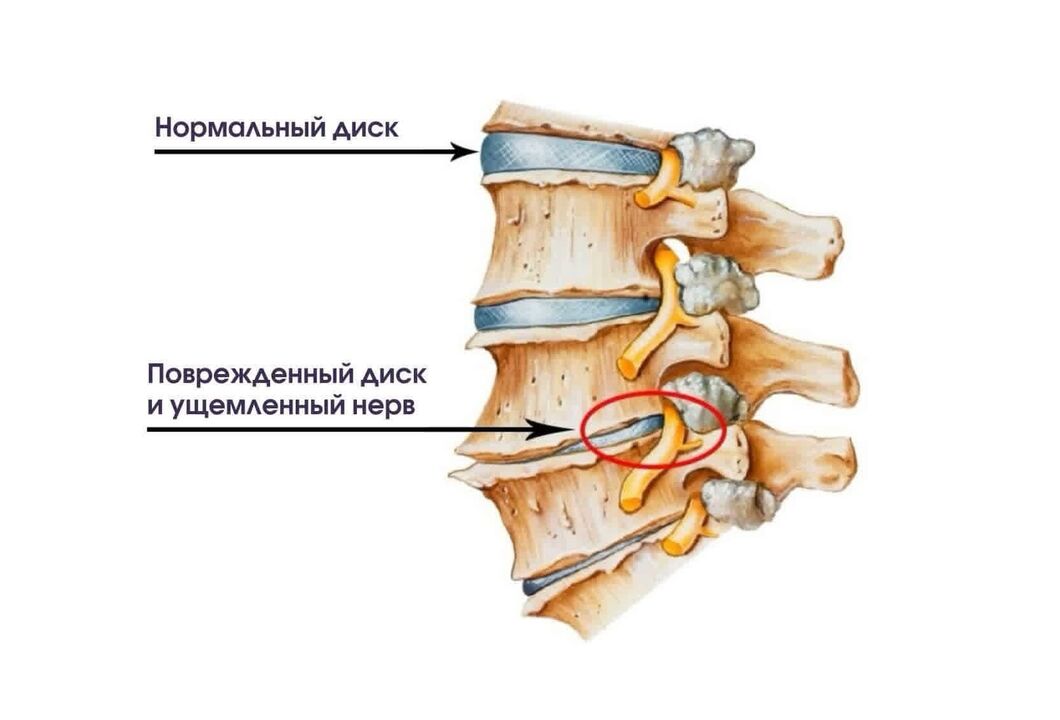 Жатын моюнчасынын остеохондрозунун симптомдору